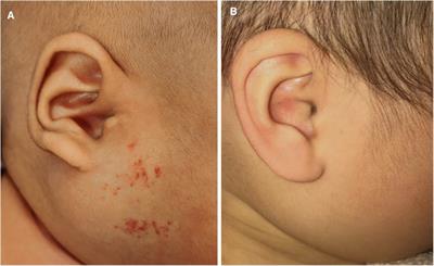 Comparison of efficacy and safety between oral propranolol combined with and without intralesional injection of lauromacrogol for infantile hemangioma